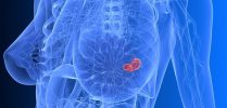 fibroadenoma-min