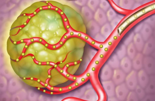 5-tumor-with-microspheres