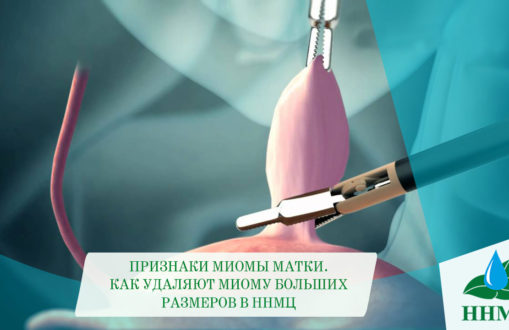 17.02. Миома