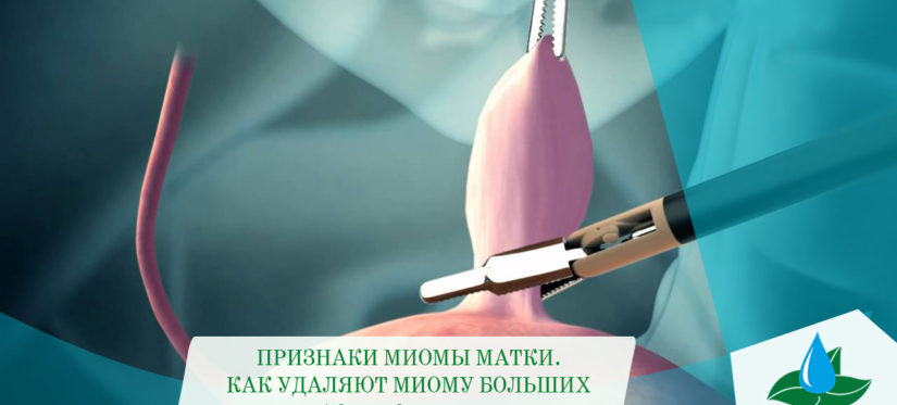 17.02. Миома